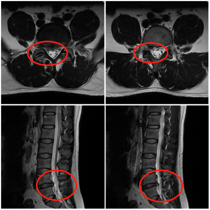 患者术前影像资料:l4-5腰椎间盘突出症该病例为典型的l4-5巨大椎间盘