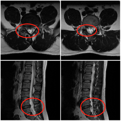 腰椎盘图片的l4l5图片