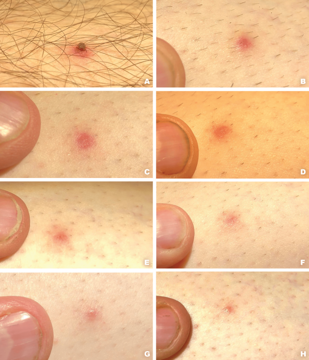 防治蜱虫叮咬,这份攻略请收好