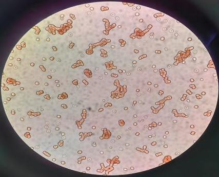 蛋白凝集对abo血型检测的干扰