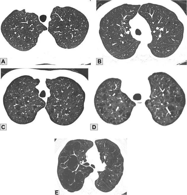 全小叶型肺气肿(panlobular emphysema ,ple)与cle不同,ple病理上主要