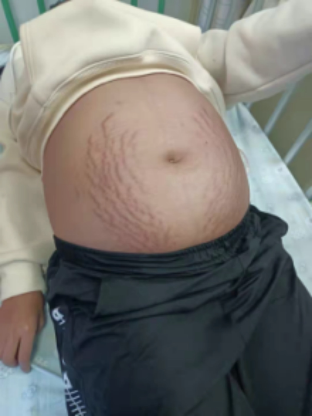 13岁女子肚子隆起爬满“妊娠纹”，照完CT妈妈当场吓懵！