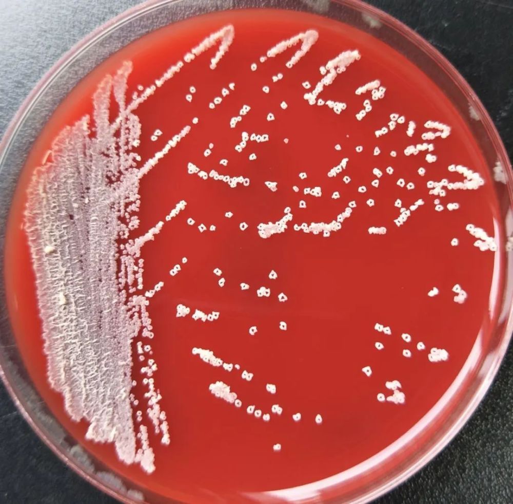 新冠患者合并圣乔治诺卡菌感染1例_腾讯新闻
