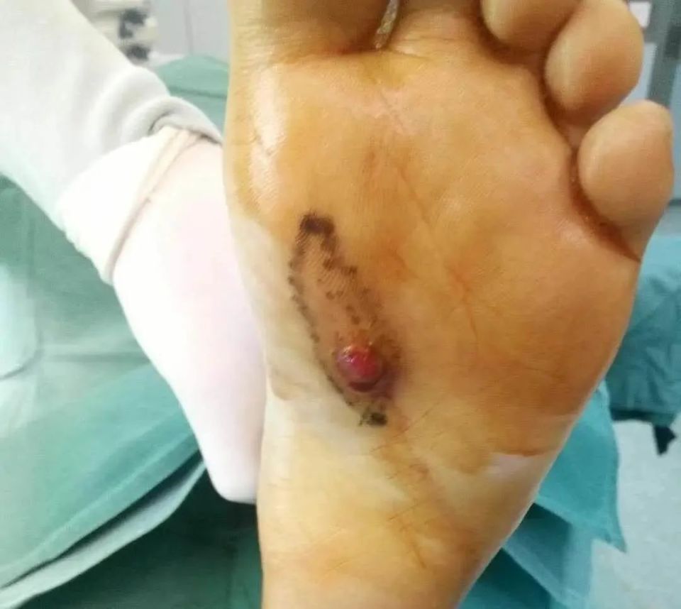 本次就诊照片:简要病史:足底反复溃疡 2 年,被诊断为肉芽肿.