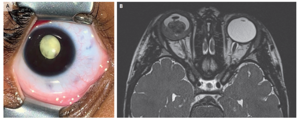 视网膜母细胞瘤眼睛图片