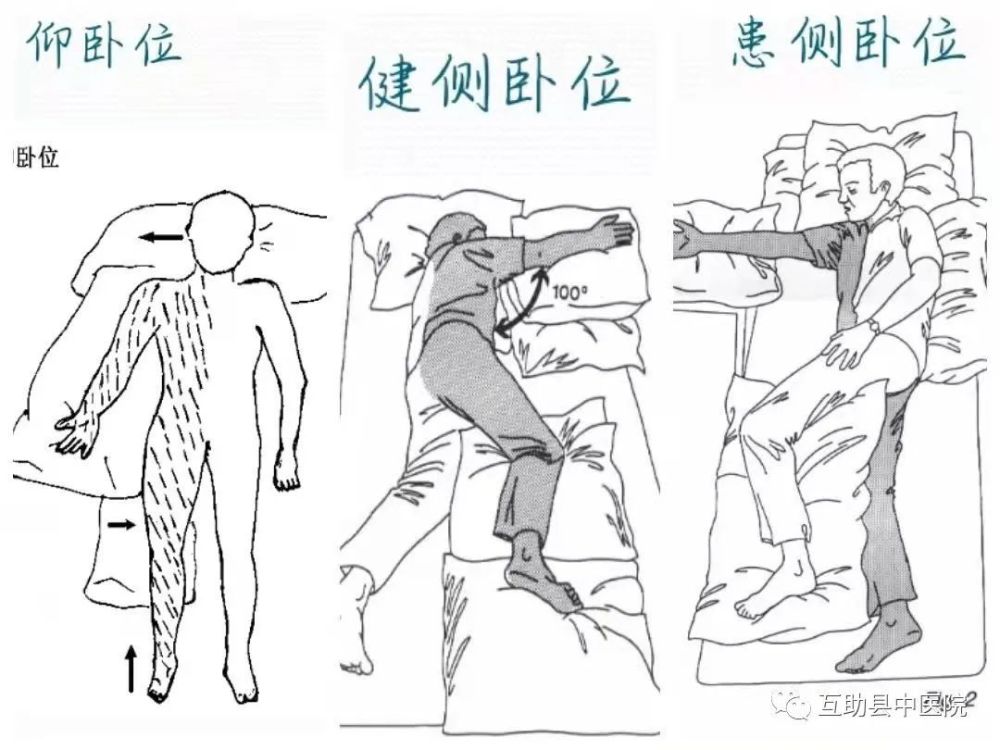 良肢位是指为防止或对抗痉挛模式的出现,保护肩,肘,手,髋,膝,踝等大