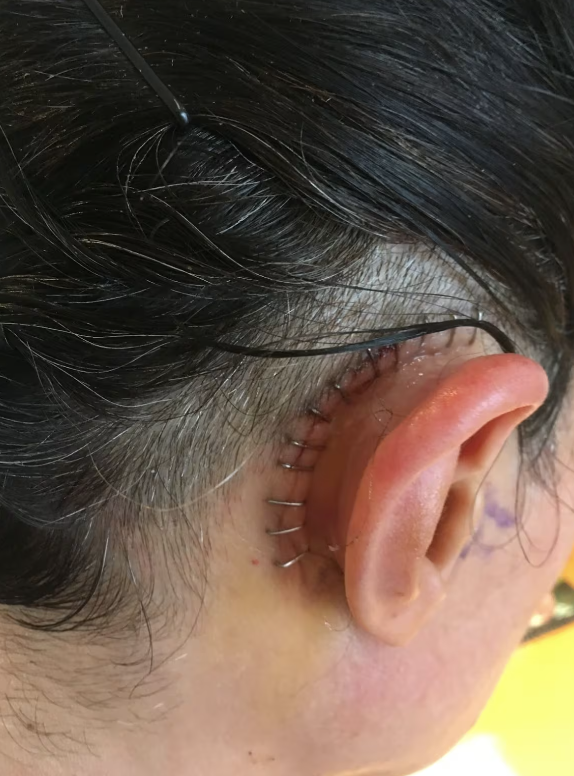 两个星期以来,我不能侧躺在伤口处.