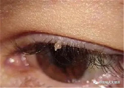 一般免疫力比较好的,以及儿童很少感染hpv病毒,平时生活中要注