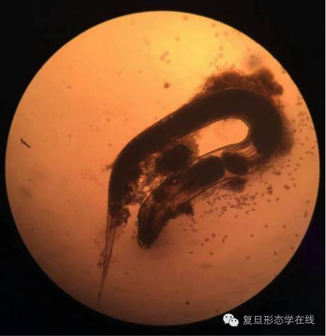 一例儿童蛲虫病的典型案例-腾讯新闻