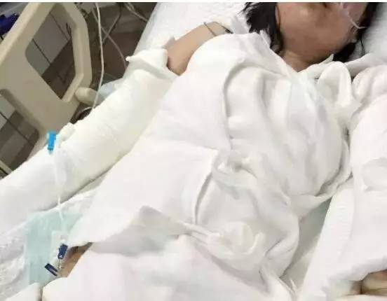 小张全身多处被热水烫伤,烫伤面积达到65%,属2度烧伤