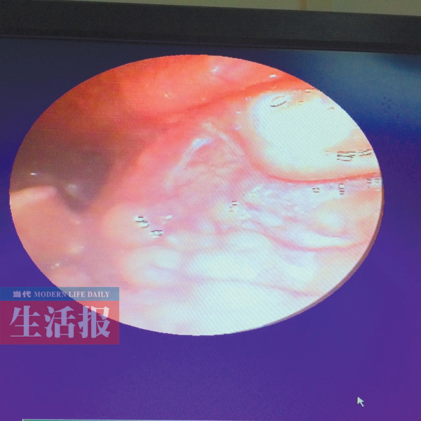 亲姐妹同吃一条鱼同时被鱼刺卡住左侧咽喉