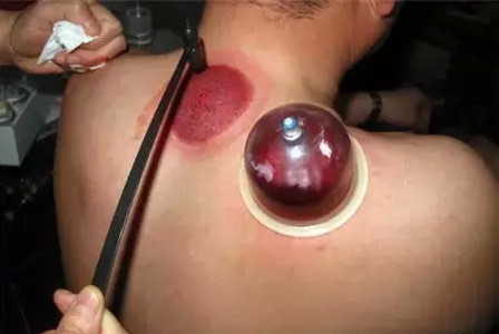 背部刺血有奇效99的人不知道