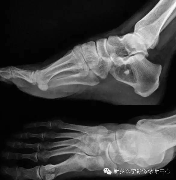 这6张跟骨图像你能分得清吗