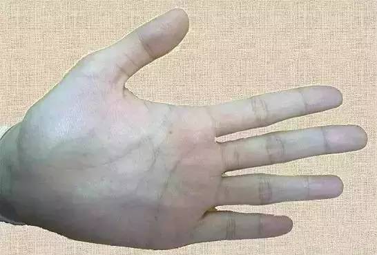 (2)手指青筋.小孩手指青筋,提示肠胃积滞消化不良.