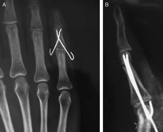 指骨颈骨折 克氏针固定的新方法 腾讯新闻