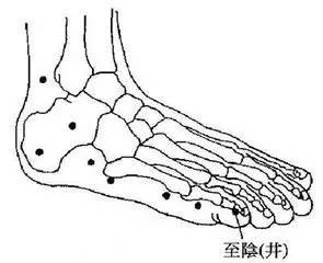 急腹三里腎精靈腹痛,針刺足三里腎絞痛,針刺精靈穴13.