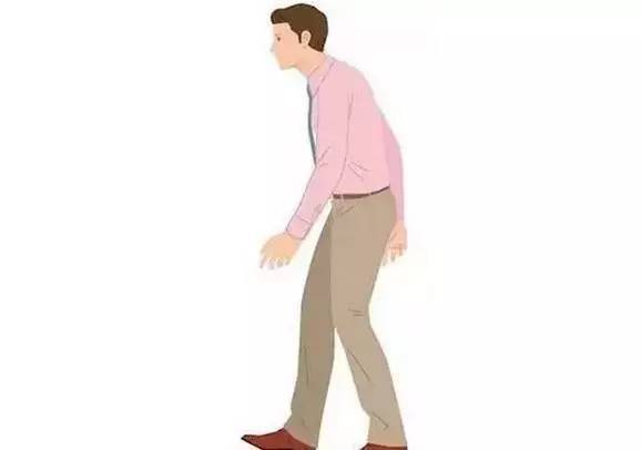 强直性脊柱炎走路姿势图片