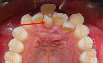 人类的牙弓也越来越小,这样导致很多人的牙齿拥挤错位,影响美观