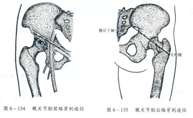 髋 膝 踝 肩 肘 腕关节穿刺图文详解 腾讯新闻