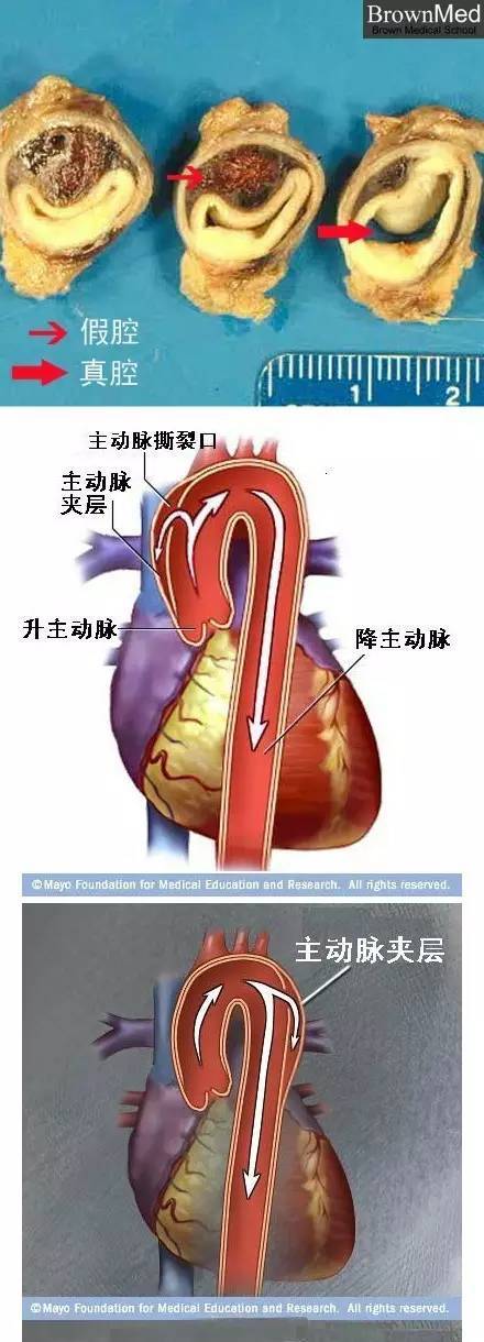 心血管疾病|心血管疾病图文详解！太珍贵了！看完全明白！