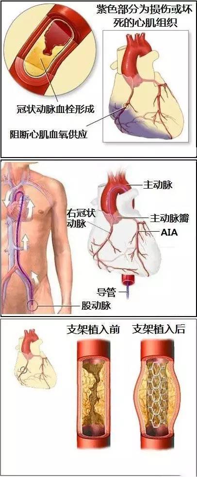 心血管疾病|心血管疾病图文详解！太珍贵了！看完全明白！