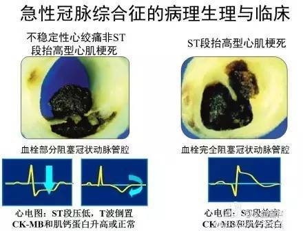 心血管疾病|心血管疾病图文详解！太珍贵了！看完全明白！