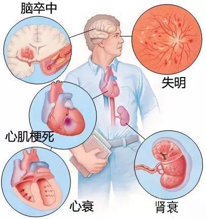 心血管疾病|心血管疾病图文详解！太珍贵了！看完全明白！