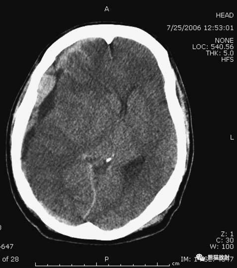 (小脑幕下)硬膜下血肿.