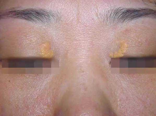 上眼皮下长起了小疙瘩,通常靠鼻侧,可以单侧或双侧同时出现,表面不