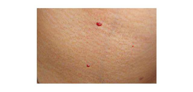 身上有这种小红痣,很可能是大病的预警信号…|蜘蛛痣|红痣|血管痣