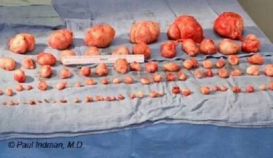 这个方子和穴位,专调肌瘤与囊肿,可惜知道的人太少了!