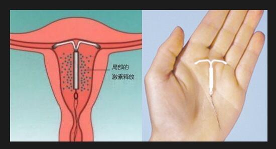 "上环"是我国育龄期妇女最常用的长效避孕措施,上环就相当于做一次