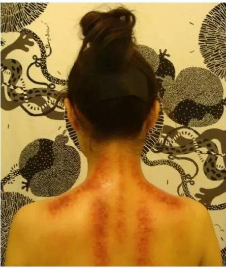 从背部痧色可以看出身体状况真的很神奇啊