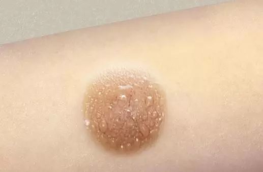 【使用禁忌】大醉大怒,大恐大惊,情绪不稳,过劳过饱时禁艾灸;皮肤过敏