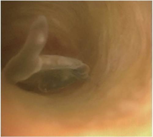 惊悚这些寄生虫能钻进你身上的每一个孔重口慎入