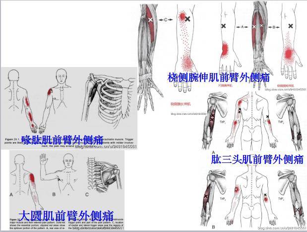 腕和手外側痛主要激痛點橈側腕短伸肌(extensor carpi radialis