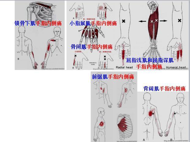 手指外側痛主要激痛點手指伸肌(extensor digitorum)骨間肌(interos