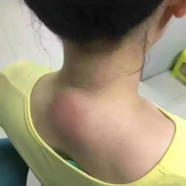 颈椎上的富贵包其实是个夺命包仅用三步轻松调理颈椎大包