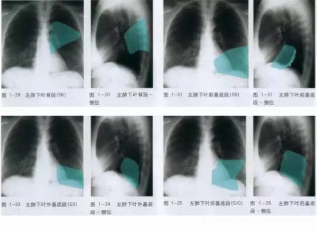 临床干货详细的胸部x线解剖最基础最实用