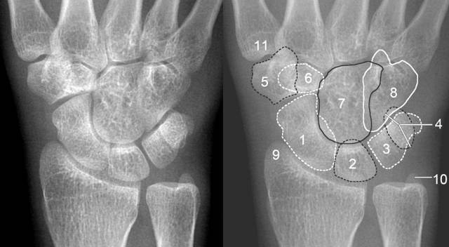 (1)正位片上:前后排腕骨后缘形成光滑的弧线;前后排腕骨不重叠;头,钩