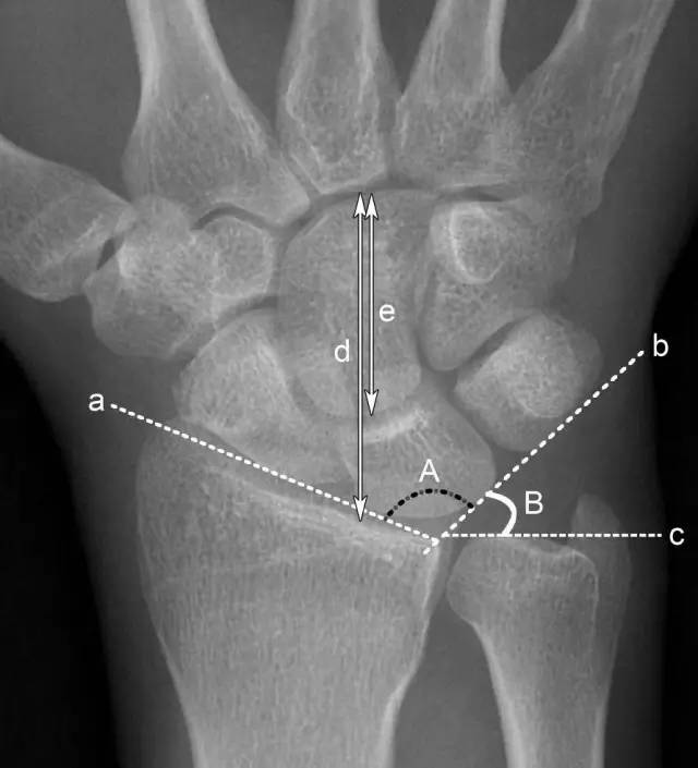 头状骨长度 a.腕骨角 b.