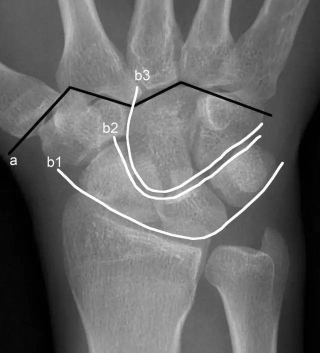 腕骨弧线(gilula线)3,如何判断是否有月骨脱位有人提出这样一种观点