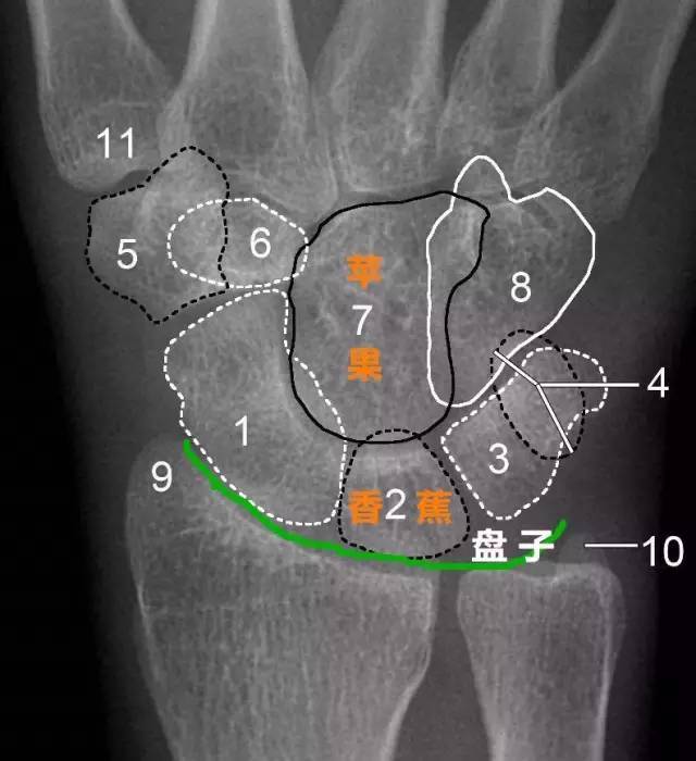 大多角骨 6.小多角骨 7.頭狀骨 8.鉤骨 9.橈骨莖突 10.尺骨莖突 11.