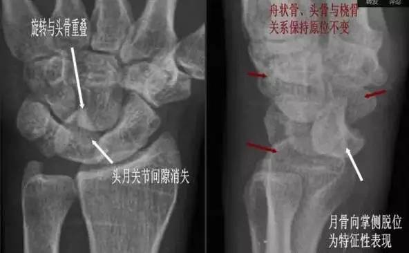 伴有舟骨骨折,且骨折近段随月骨一起向前脱位,骨折远段仍处于原位置