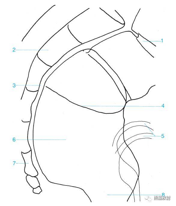 1 rectosigmoid junction 直腸乙狀結腸連接部,2 sacrum 骶骨,3 retro