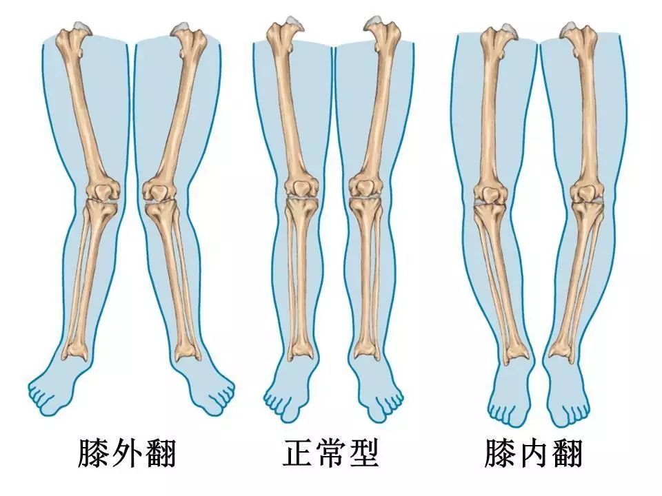 长年累月会出现关节变形,以「o 型腿」最多见