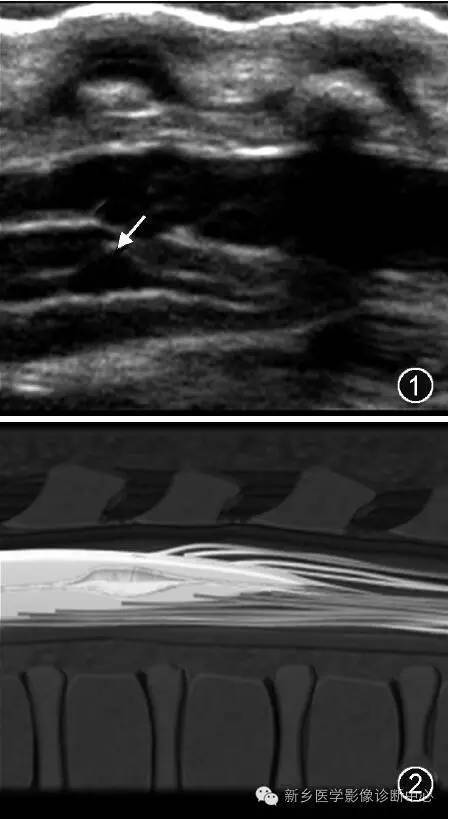 脊髓|“第五脑室”不是“透明隔间腔”，那它在哪里？