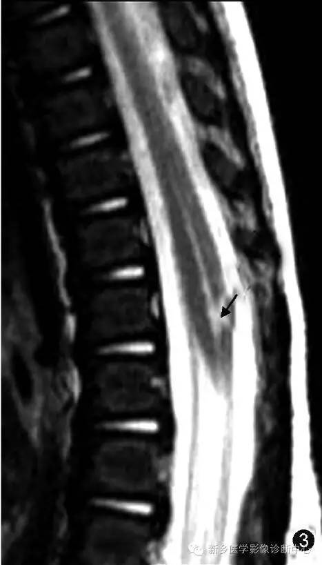 脊髓|“第五脑室”不是“透明隔间腔”，那它在哪里？
