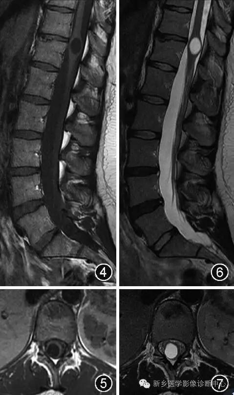 脊髓|“第五脑室”不是“透明隔间腔”，那它在哪里？