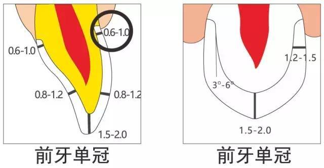 牙醫必備牙體預備及全瓷牙備牙要求